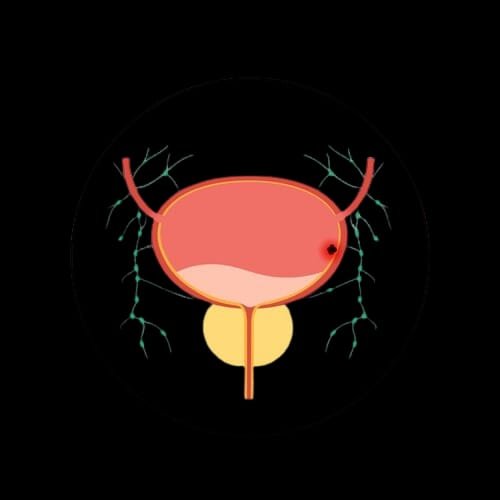 Bladder Cancer