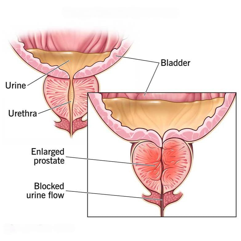 Benign Prostate Hyperplasia