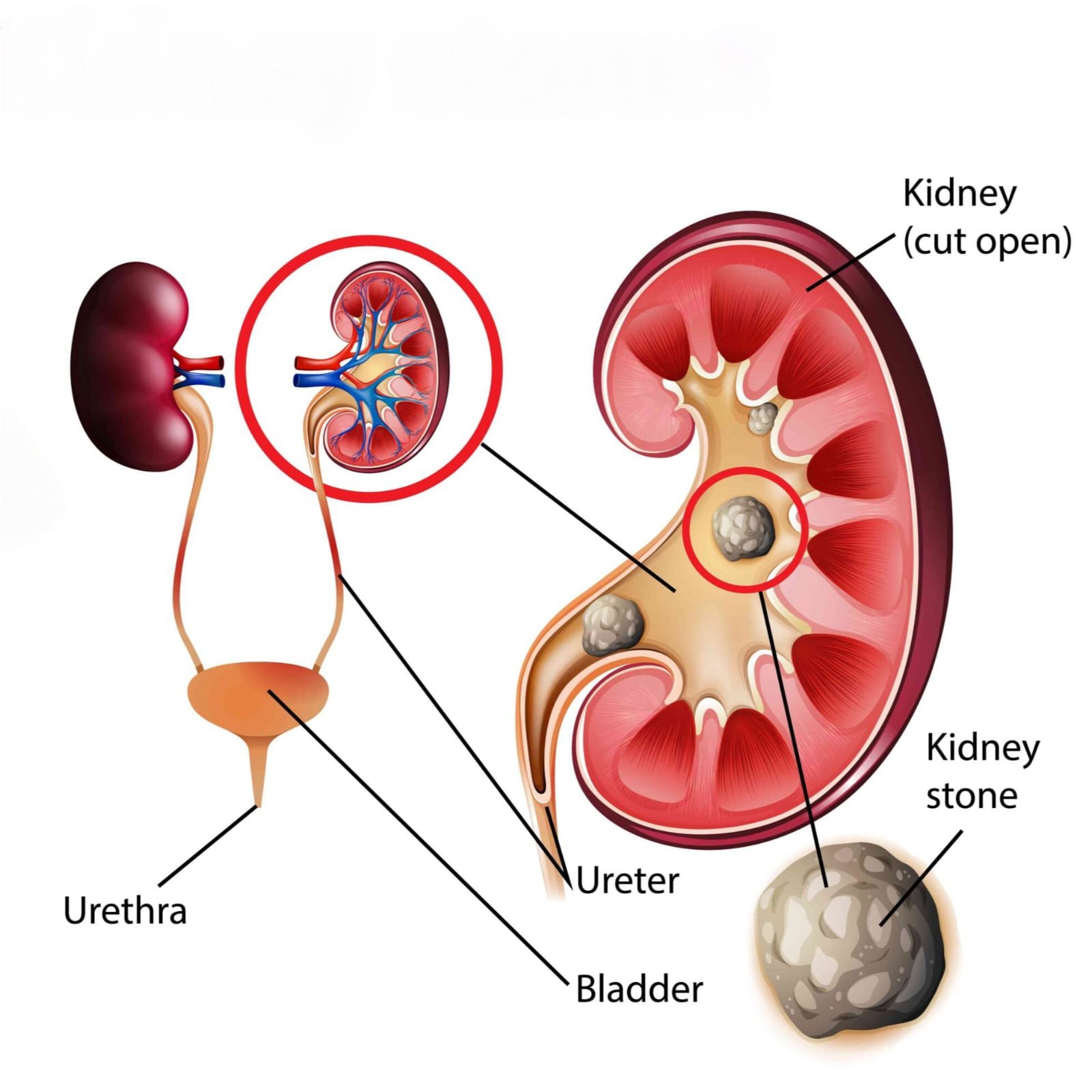 Kidney Stones