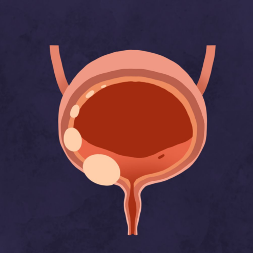Bladder Cancer