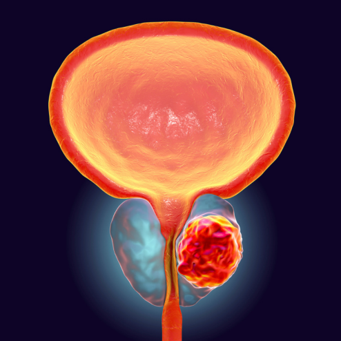 Prostate Cancer