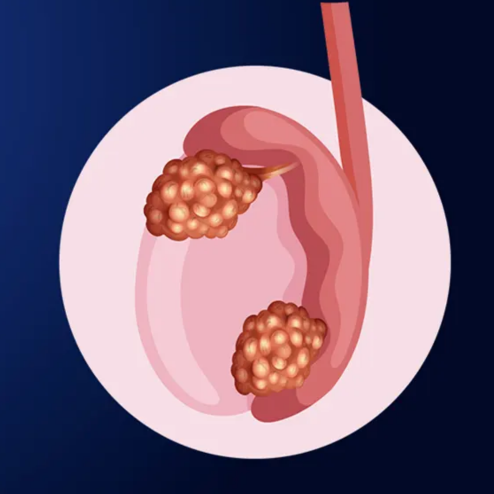 Testicular Cancer