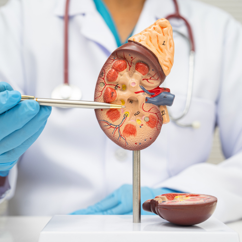 Kidney Stones